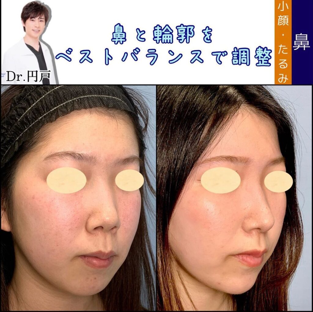 鼻先と輪郭を調整した症例