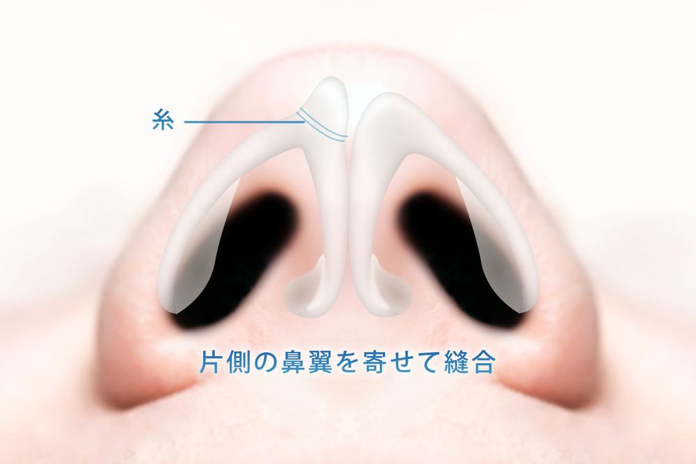 トランスドーマルスチャー法の図解
