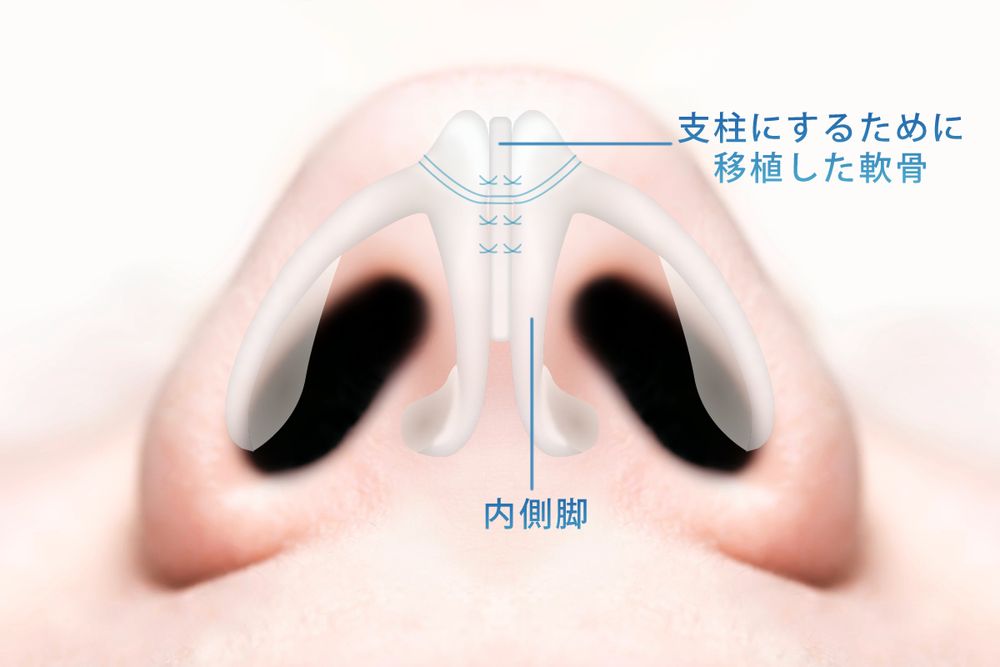 コルメラストラット法の図解