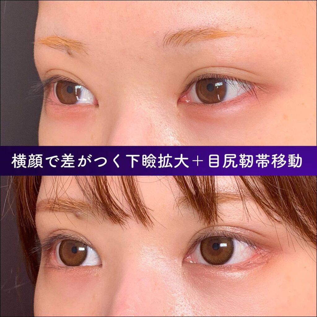 下瞼拡大と目尻切開の症例写真 (1)