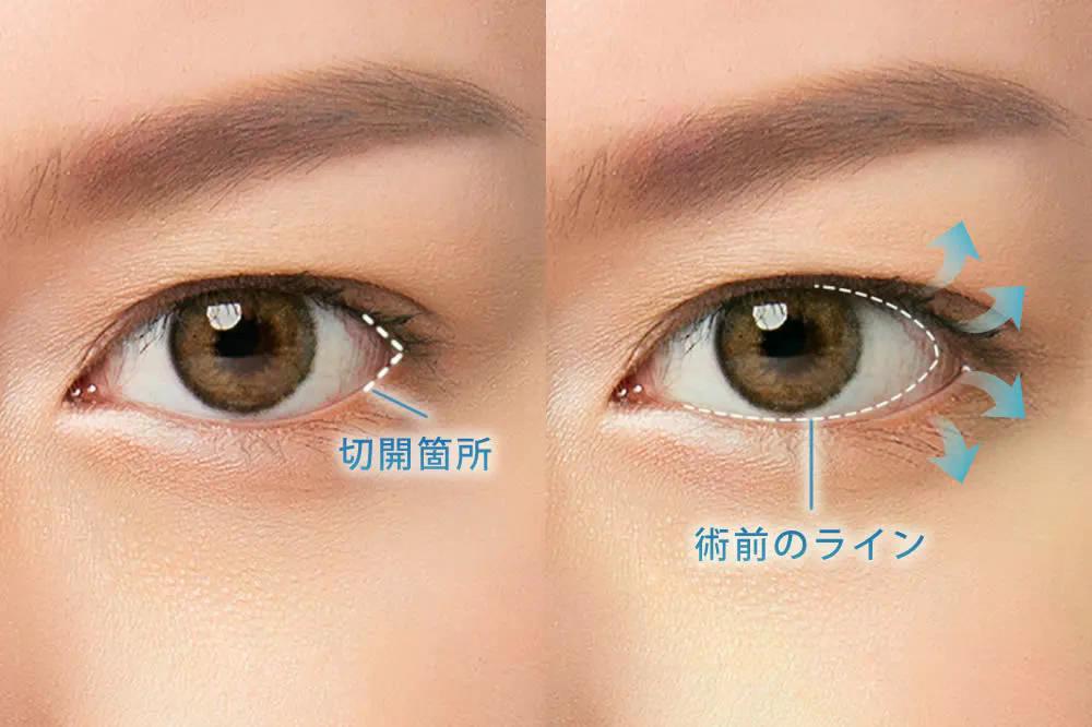 目尻切開の切開箇所と術前のライン
