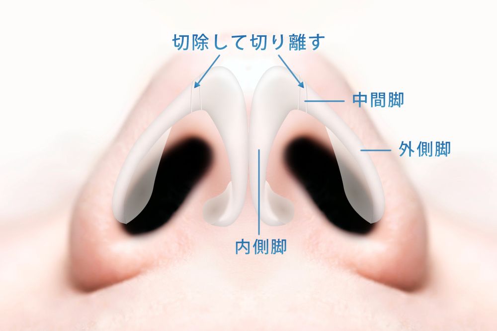 ターディ法の中間脚部分の軟骨を一部切り離なす図解