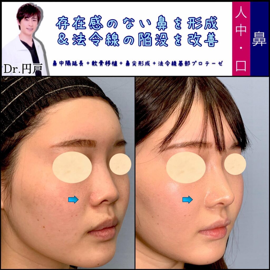 存在感の無い鼻を形成＆法令線の陥没を改善した症例写真