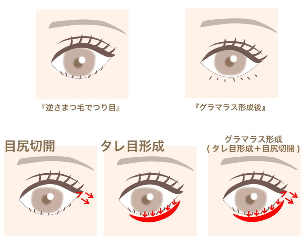 逆さまつ毛の修正方法