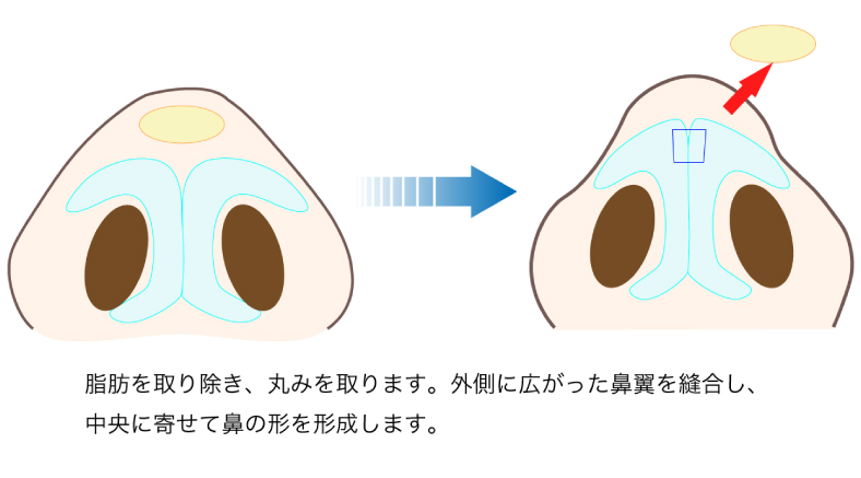 鼻尖形成の図解