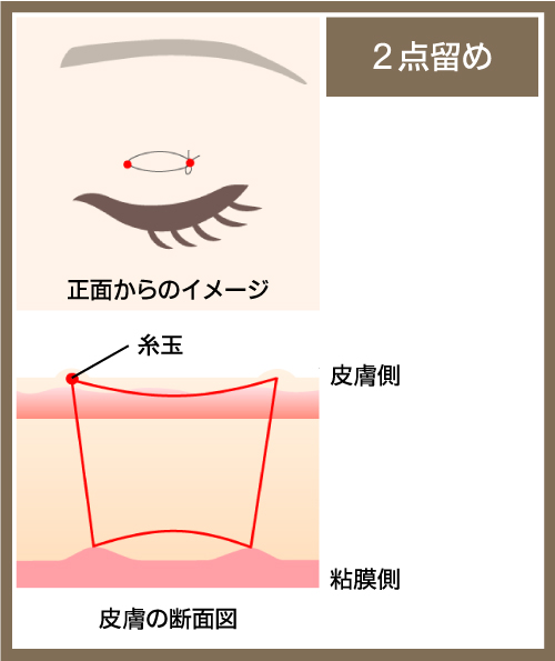 2点留めの図解