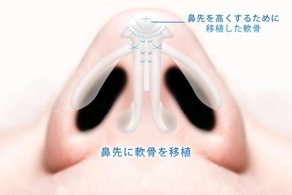 鼻尖軟骨移植とターディ法の組み合わせの図解