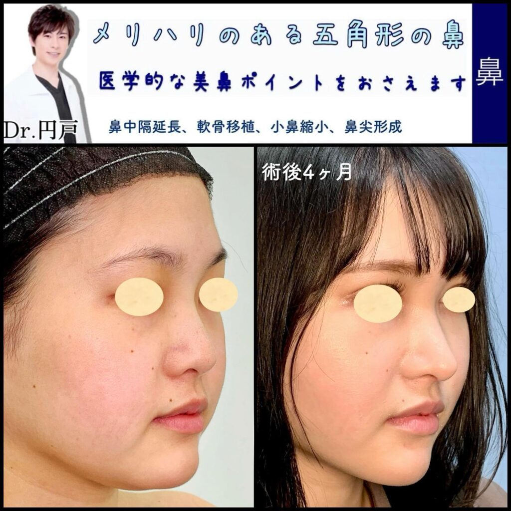 メリハリのある五角形の鼻にした症例写真