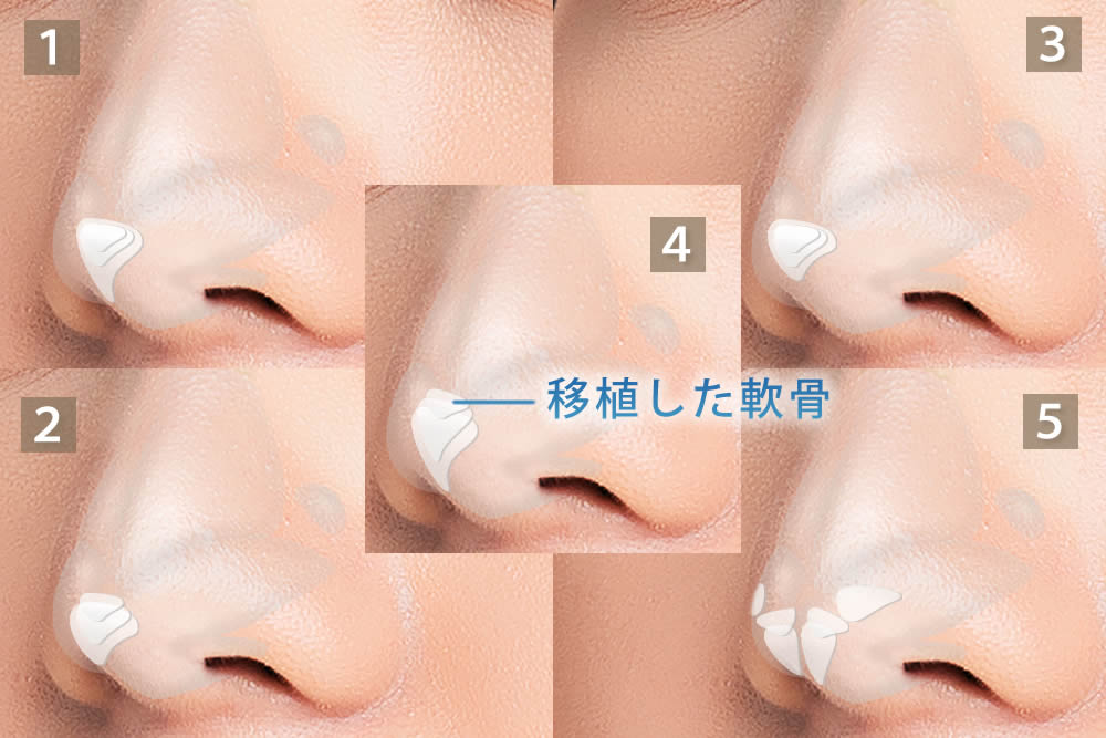 鼻尖軟骨移植のパターン説明図解