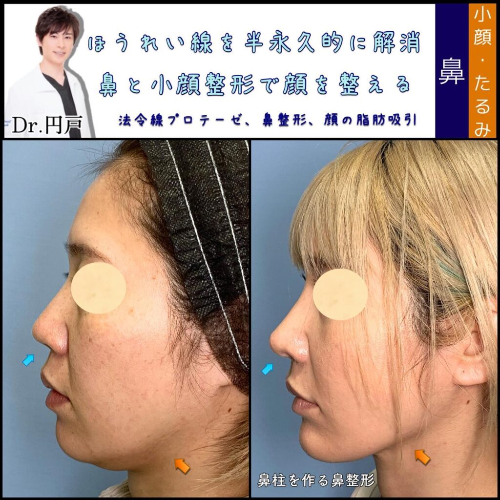 法令線プロテーゼと顔の脂肪吸引の症例写真