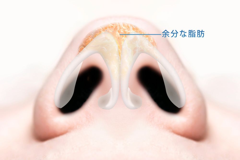 余分な脂肪の除去説明画像