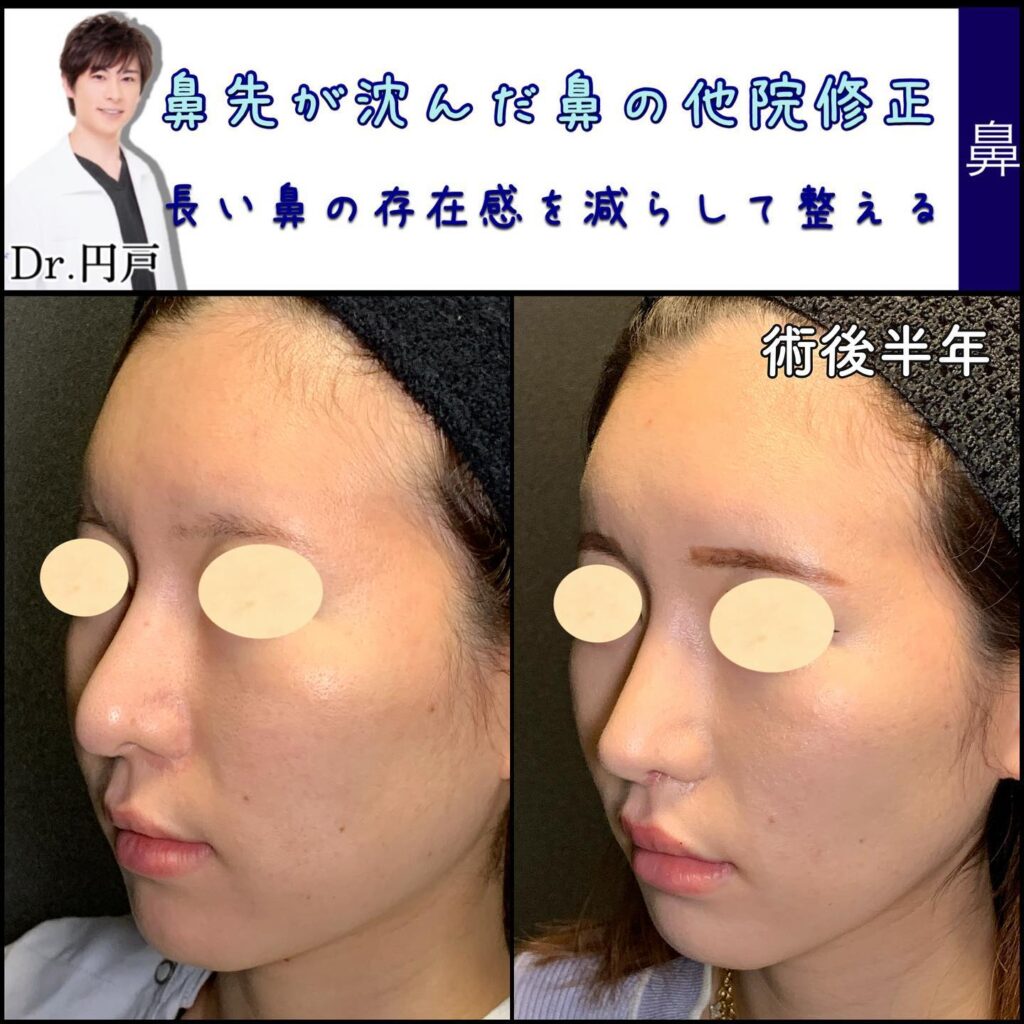長い鼻の存在感を減らして整える鼻整形の症例写真