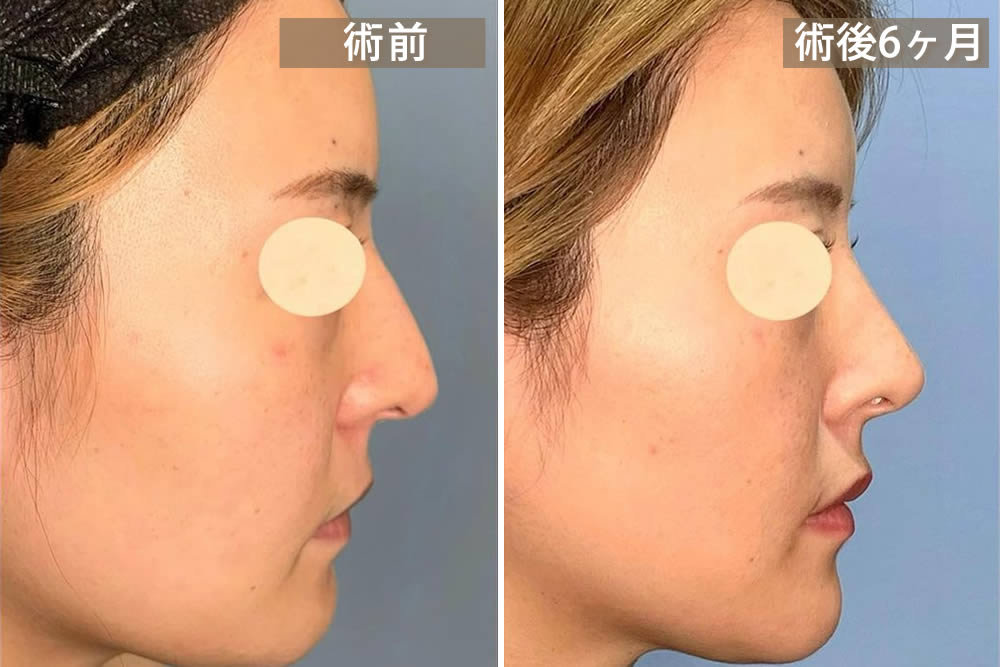 四角形のストレートの鼻の説明画像