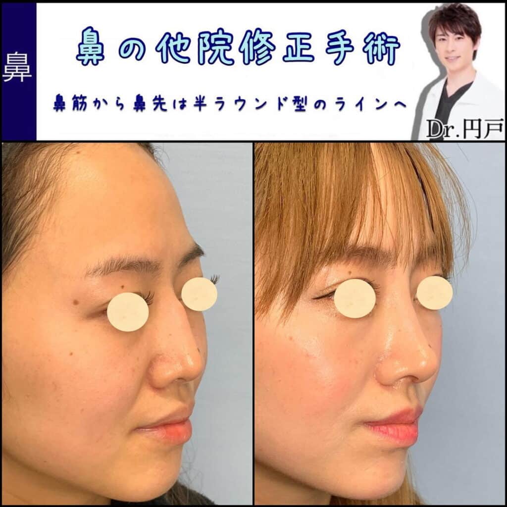 鼻整形の症例写真
