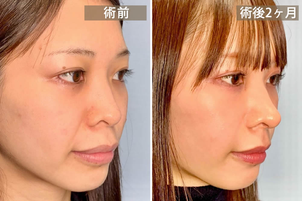 軟骨移植と鼻中隔延長手術の症例写真