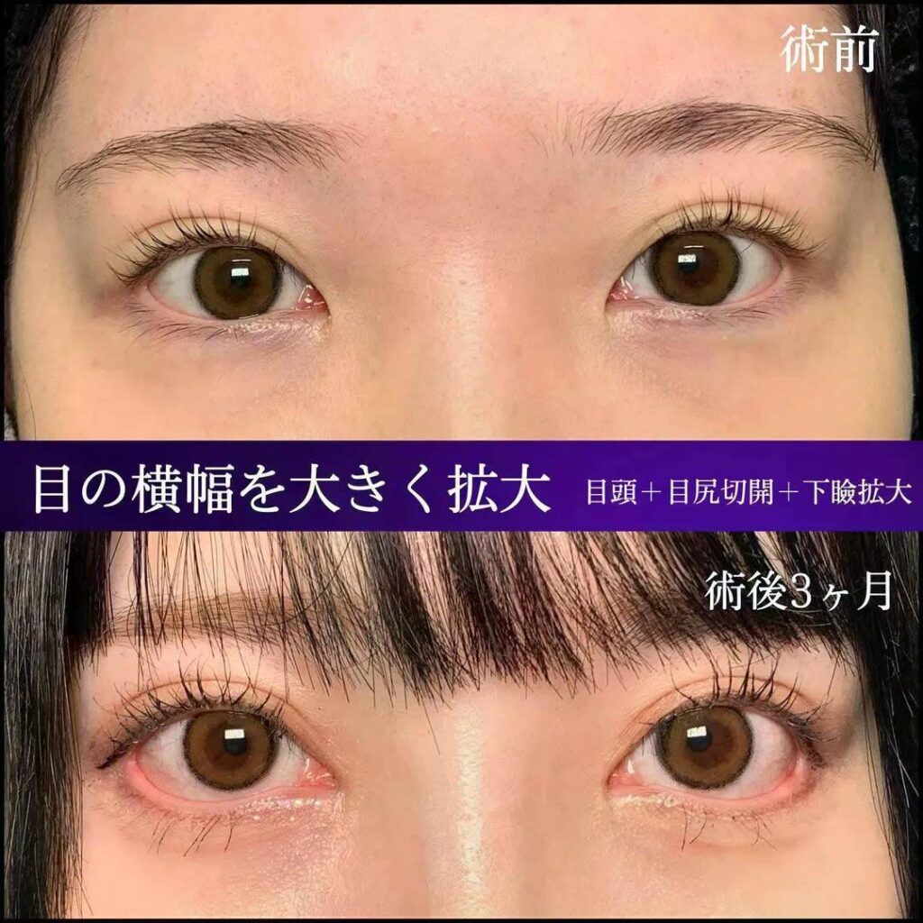 目頭切開と目尻切開と下瞼拡大の症例写真