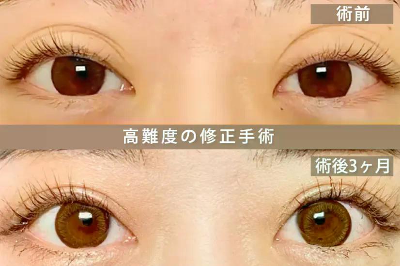 高難易度の修正手術の写真