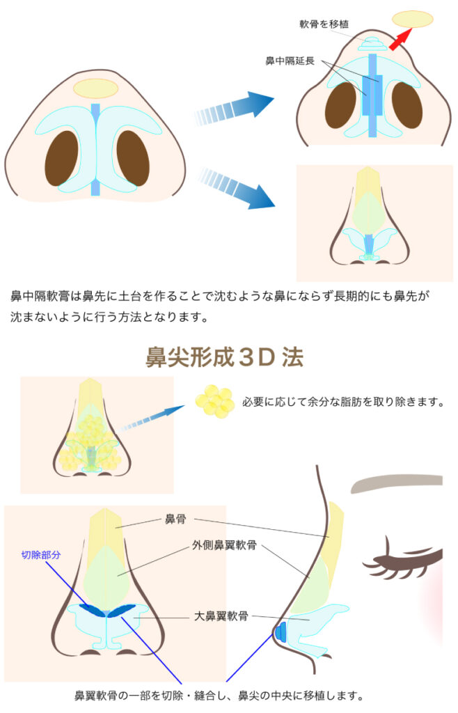 鼻尖形成3Dと鼻中隔延長の図解