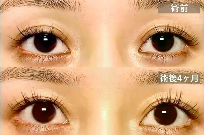 全切開後の眠たそうな目の状態の修正写真