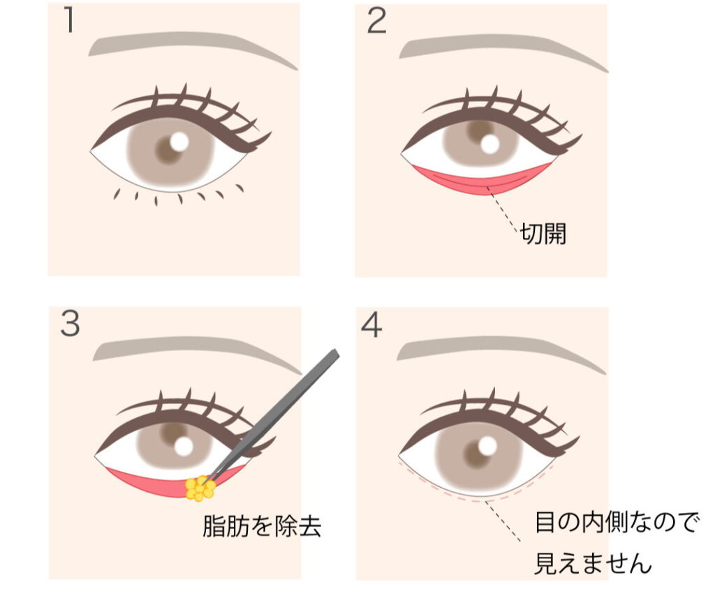 経結膜脱脂(眼窩脂肪除去)の図解