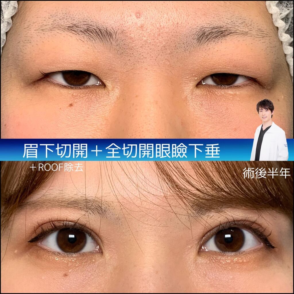 眉下切開と全切開の症例写真