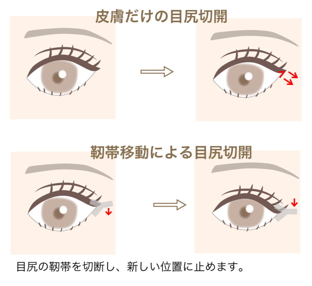 目尻切開とタレ目形成の図解