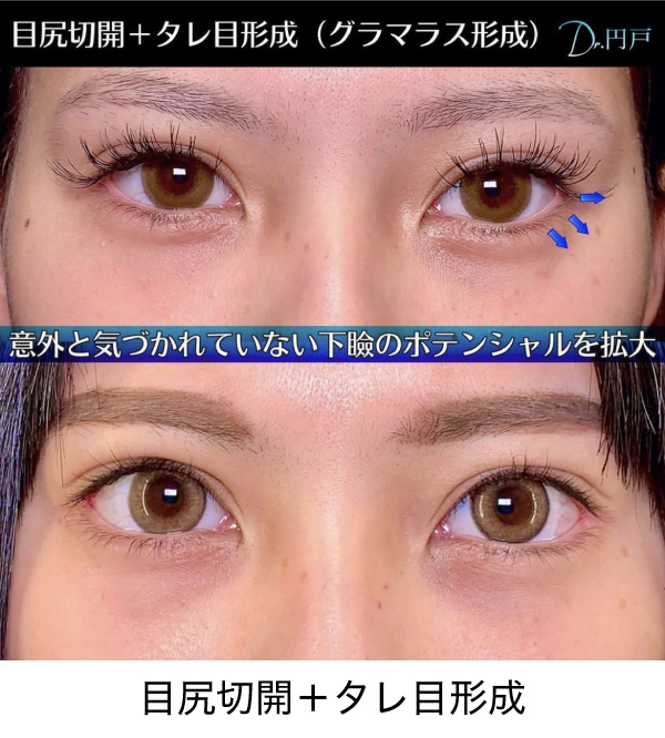 目尻切開とタレ目形成の症例写真