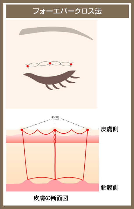 フォーエバークロス法の図解