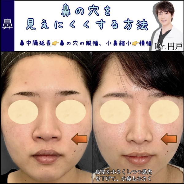 鼻の穴を見えにくくした症例写真