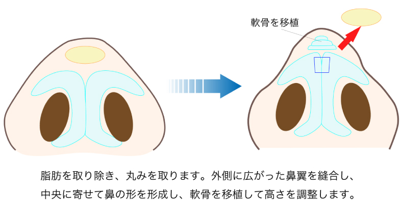 軟骨移植の図解