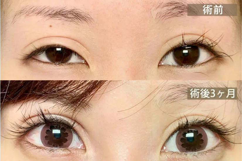 全切開の左右差の修正写真