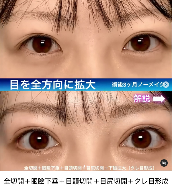 目の全方向拡大の症例写真