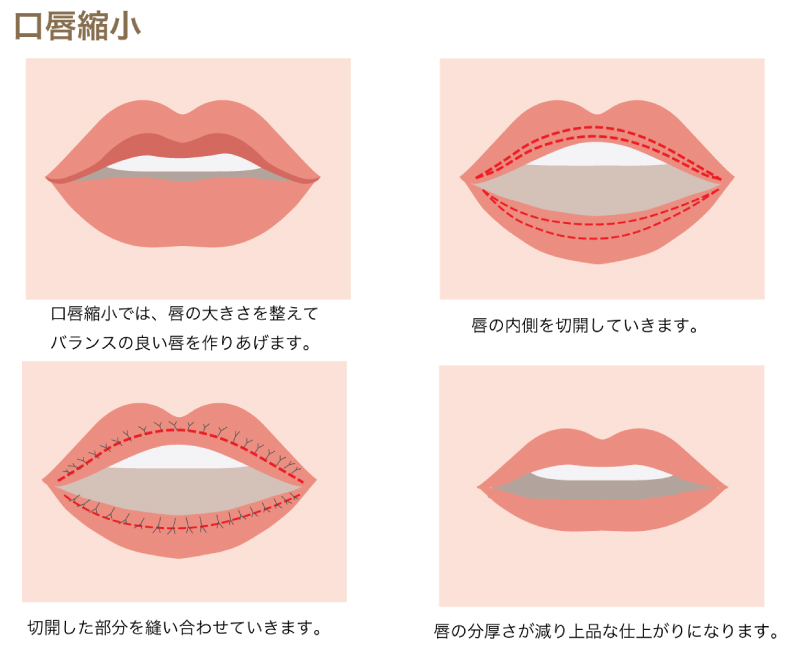唇縮小の説明の図解