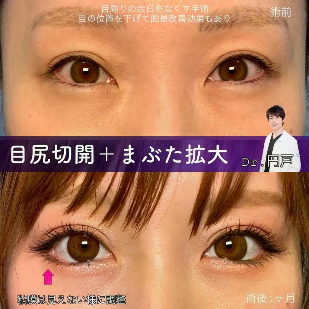 目尻切開とまぶた拡大の症例写真