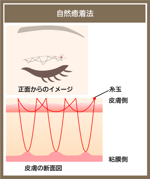 自然癒着法の図解