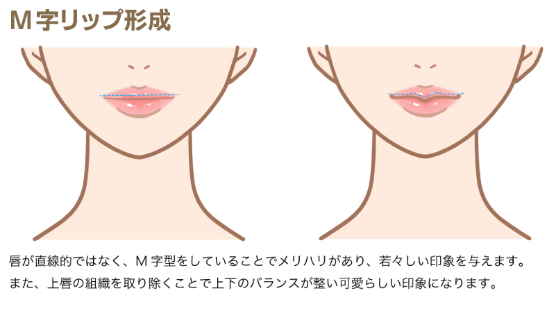 M字リップ形成の説明の図解