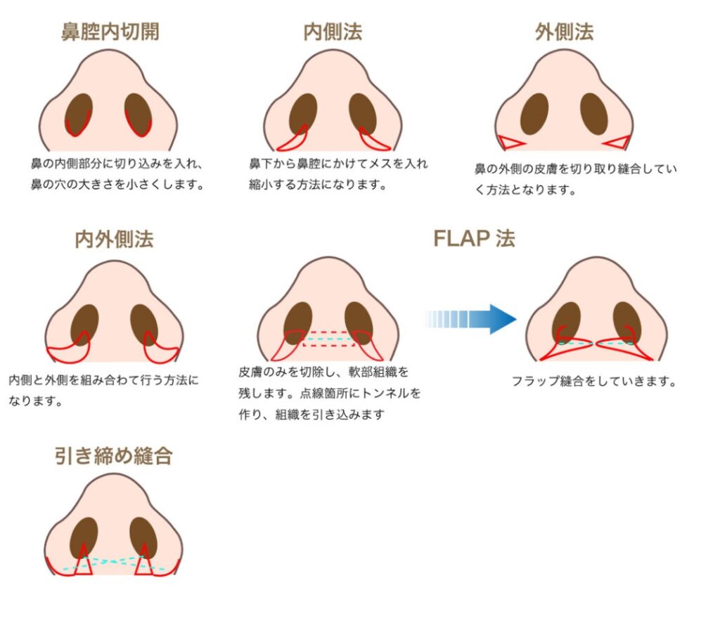 小鼻縮小の説明の図解