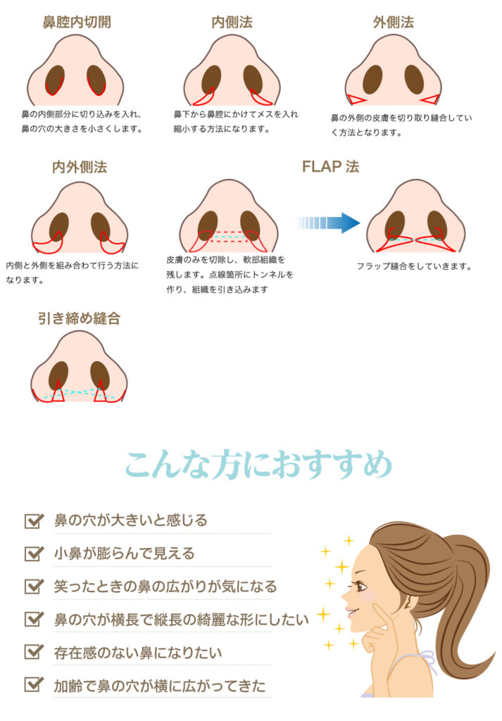 小鼻縮小の説明の図解