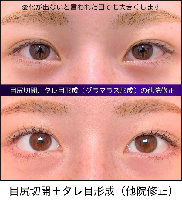 目尻切開とタレ目形成の諸例写真