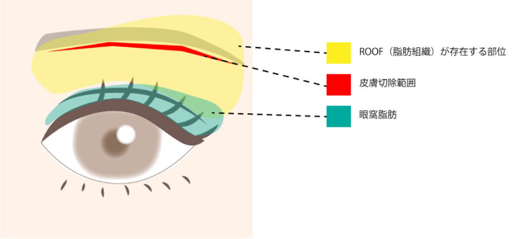 眉下切開の説明の図解