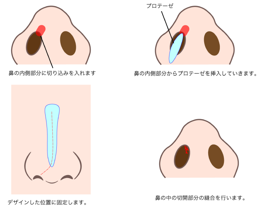 プロテーゼの挿入方法