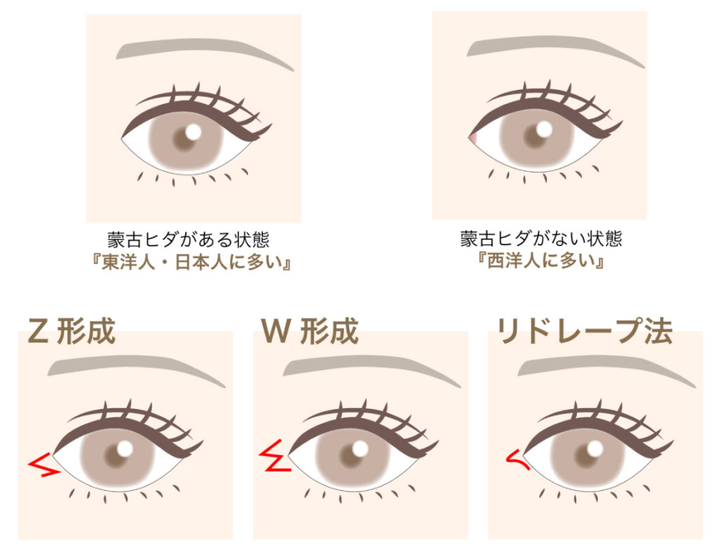 目頭切開の切開方法の画像