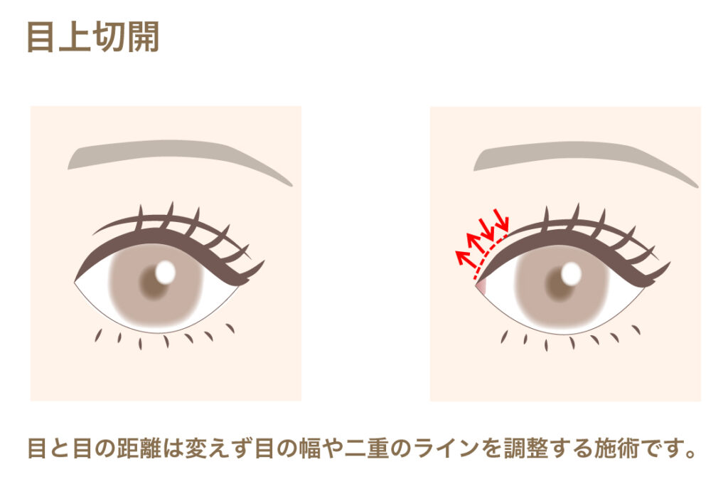 目上切開お施術方法の画像