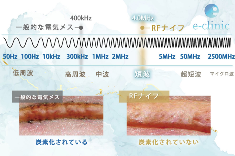 RFナイフの説明