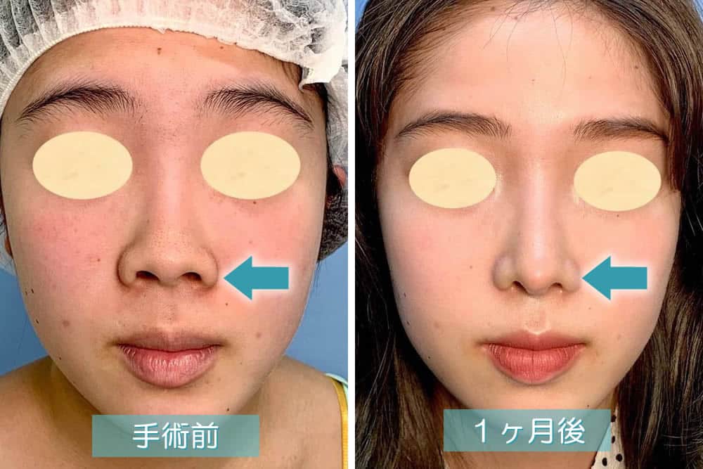 鼻尖形成の症例写真