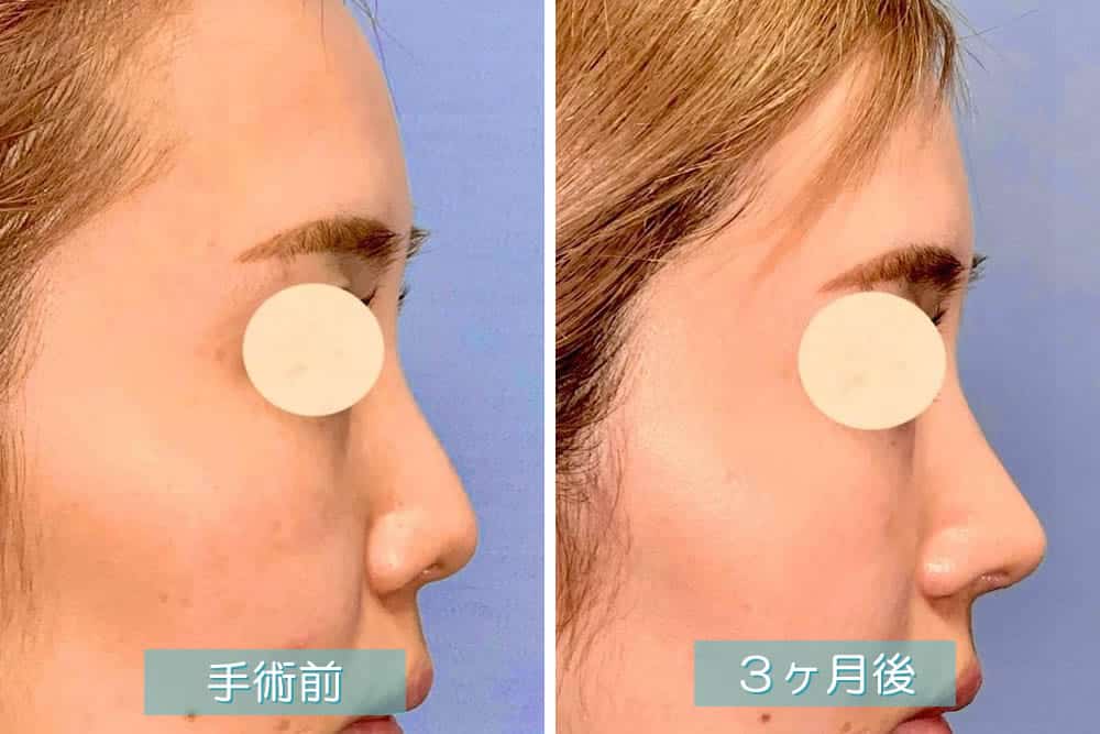 鼻尖形成3D法・鼻尖部軟骨移植の症例写真