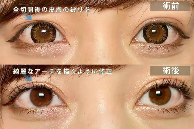全切開の手術後の二重幅の修正の写真