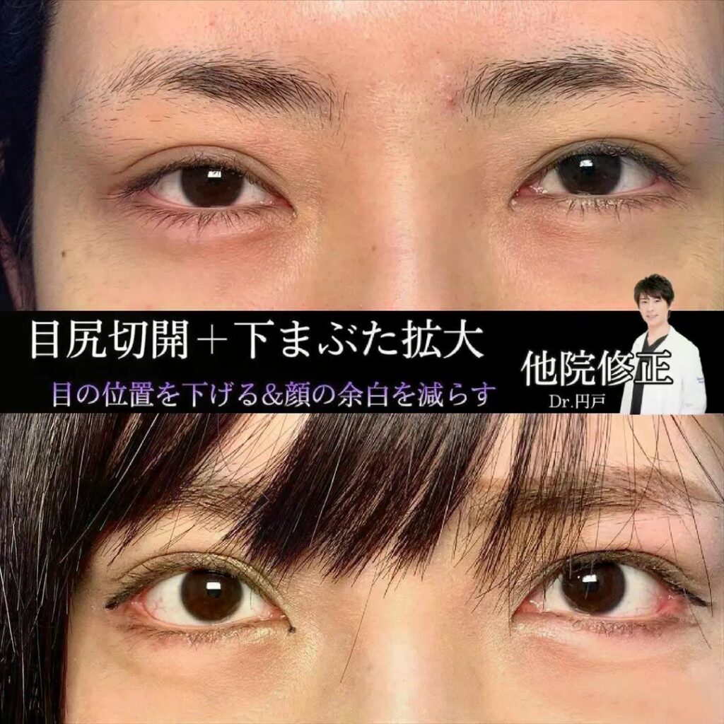 目尻切開と下まぶた拡大の症例写真