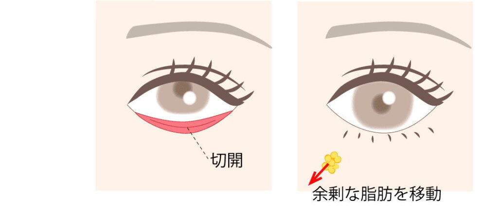 裏ハムラ法(脂肪再配置)の図解