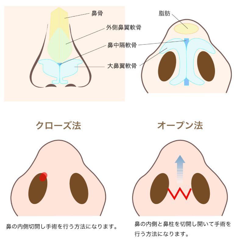 クローズ法とオープン法の説明
